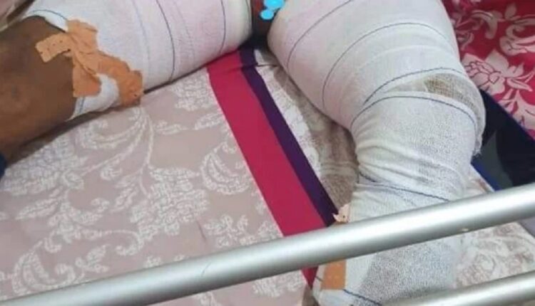 Cameroun Une femme brule les parties génitales de son époux à Yaoundé