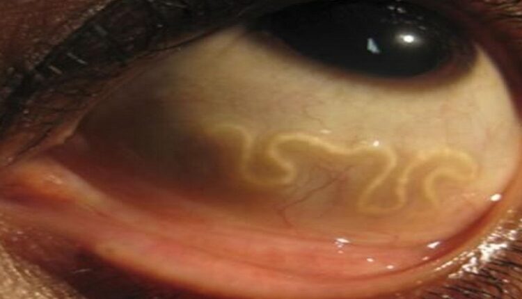 Infecté par la toxocarose